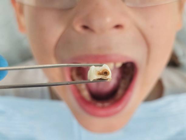Best Knocked-Out Tooth (Avulsed Tooth) Treatment in Tonawanda, NY
